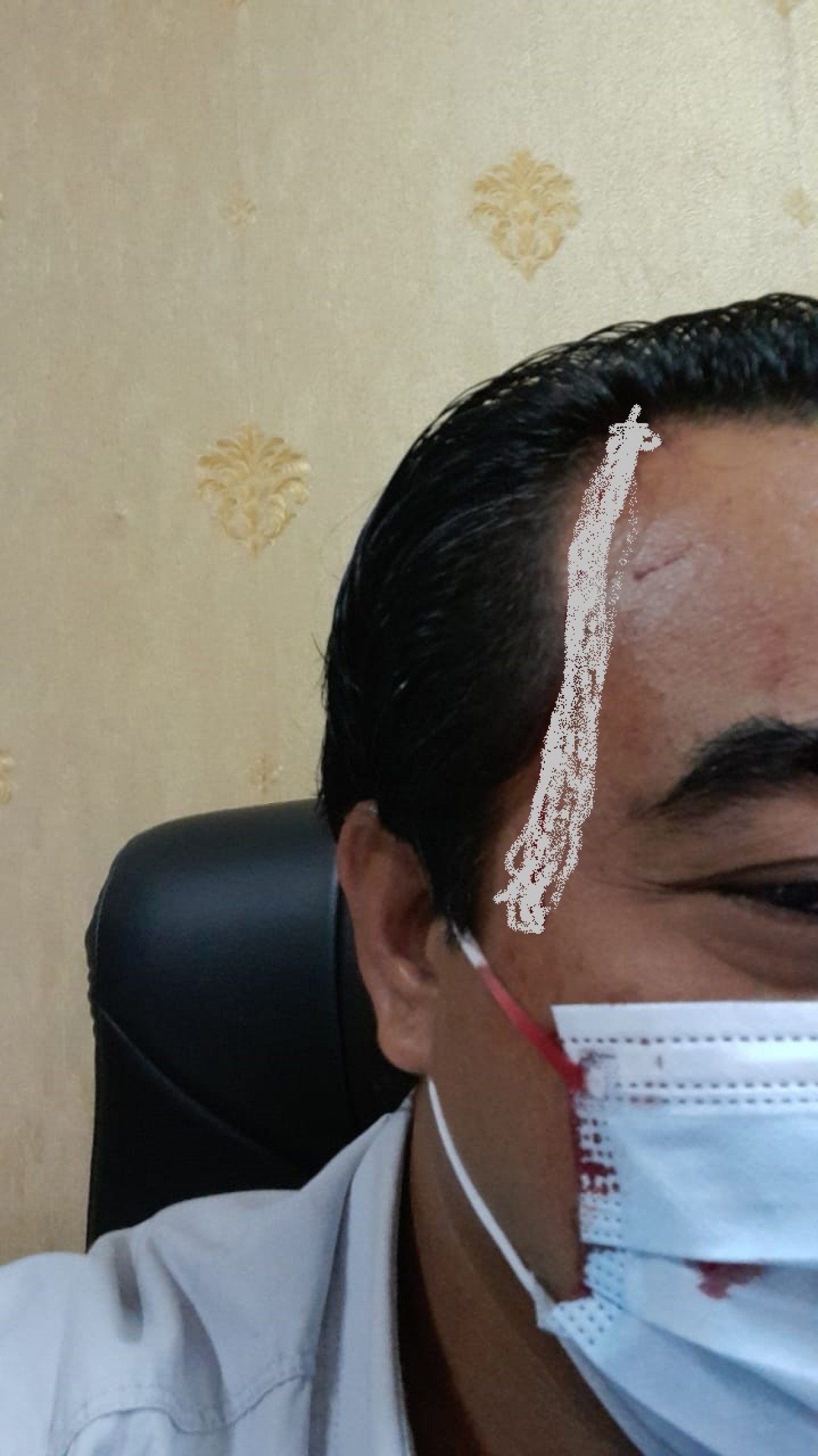 Piter Buyang : Saya Dipukul Dengan Vas Bunga Hingga Kepala Berdarah